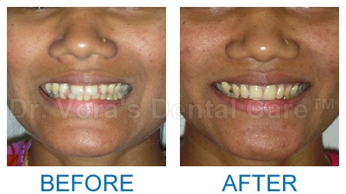 Adult teeth correction