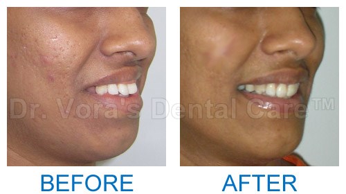 Adult teeth correction