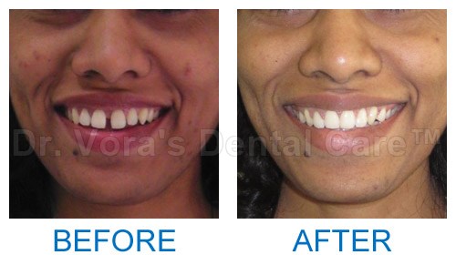 Adult teeth correction