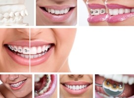 Types of Braces Introduction