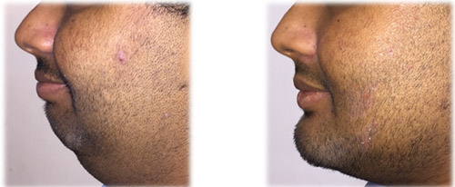 Jaw Surgery