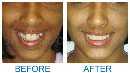 Crocket teeth correction