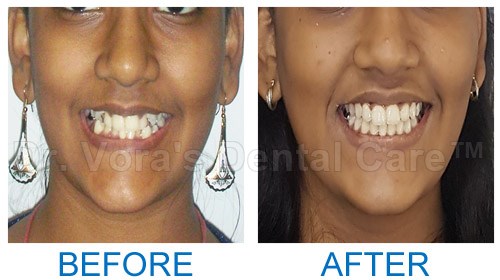 Crocket teeth correction