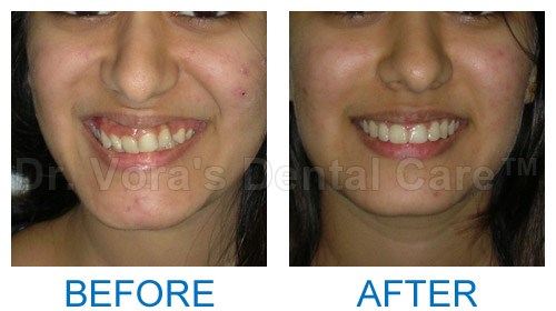 Gummy smile correction