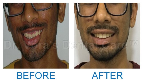 Gummy smile correction