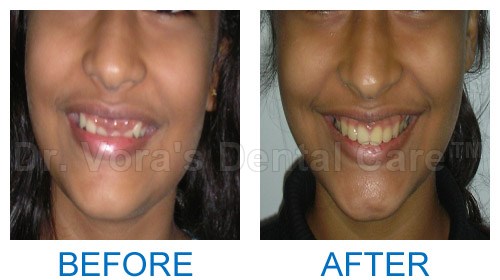 Gummy smile correction