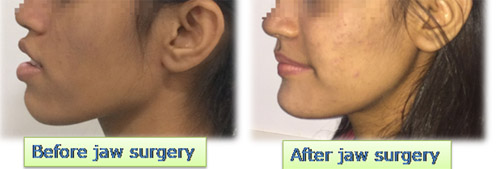 Jaw Surgery