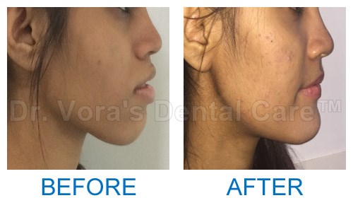 Surgical jaw correction