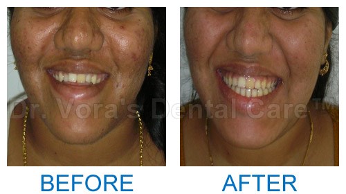 Surgical jaw correction