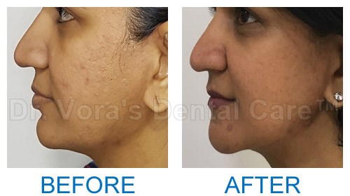 Surgical jaw correction