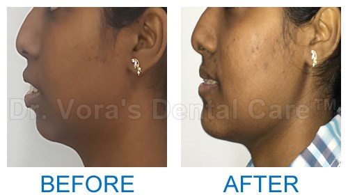 Surgical jaw correction