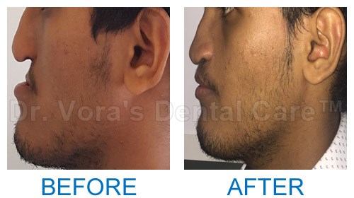 Surgical jaw correction